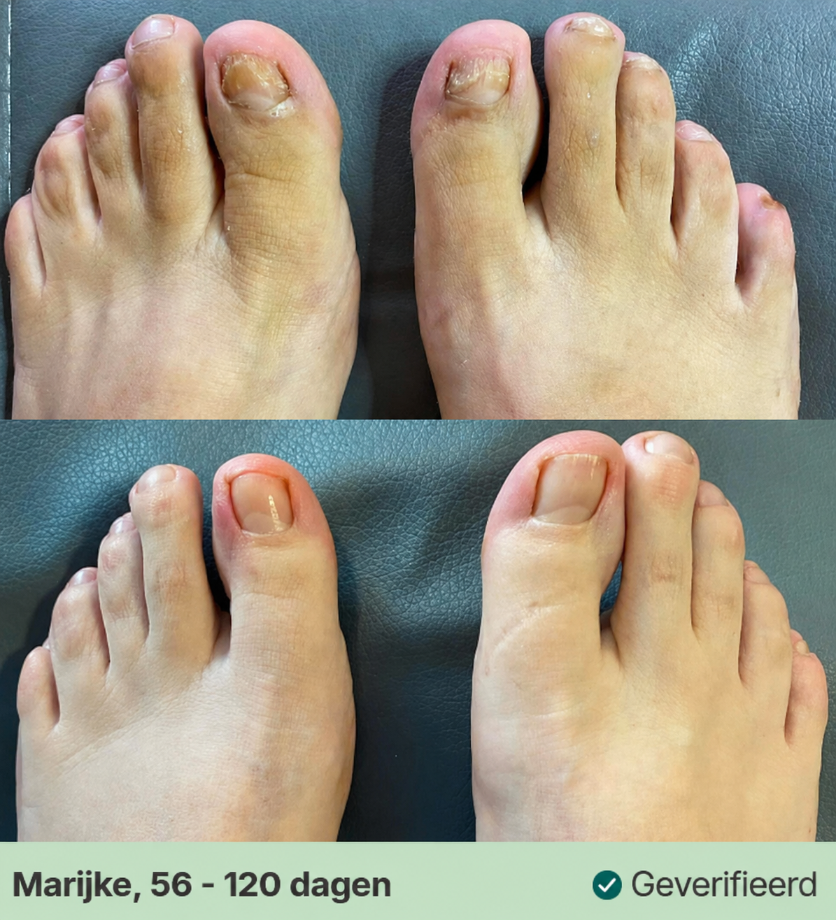 Kalknagel Verzorgingspen voor Verkleurde Nagels 3 ml
