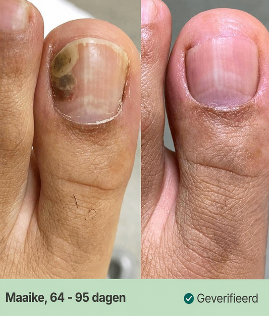 Kalknagel Verzorgingspen voor Verkleurde Nagels 3 ml
