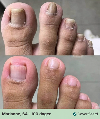 Kalknagel Verzorgingspen voor Verkleurde Nagels 3 ml