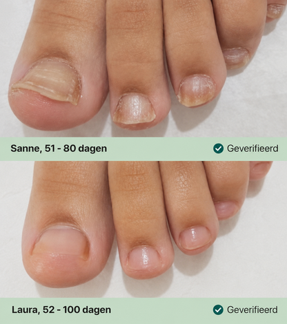 Kalknagel Verzorgingspen voor Verkleurde Nagels 3 ml