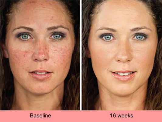 Niacinamide Serum met 4% Kojic Acid voor Pigmentvlekken 50 ml